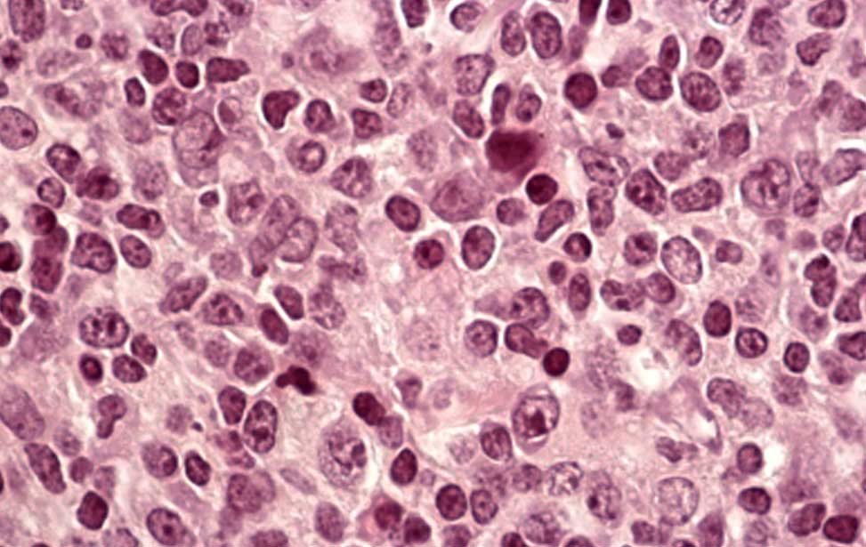 Diffuse Large B-cell lymphoma